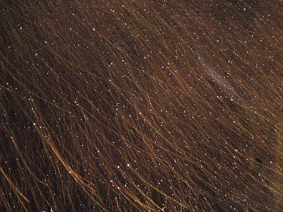 Πιτυρίδα: διώξτε το χιόνι από το κεφάλι σας